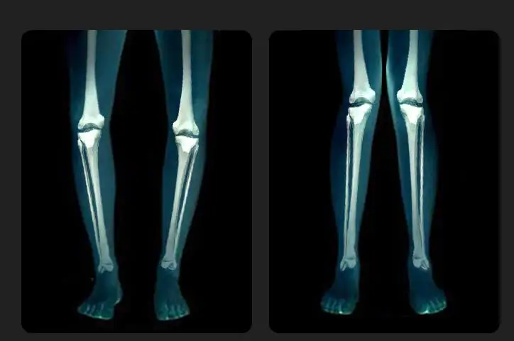 Õige xo jalg ortopeedia o-jalg säärised vööri-jalg sirge jalg artefakt jalg parandus 1
