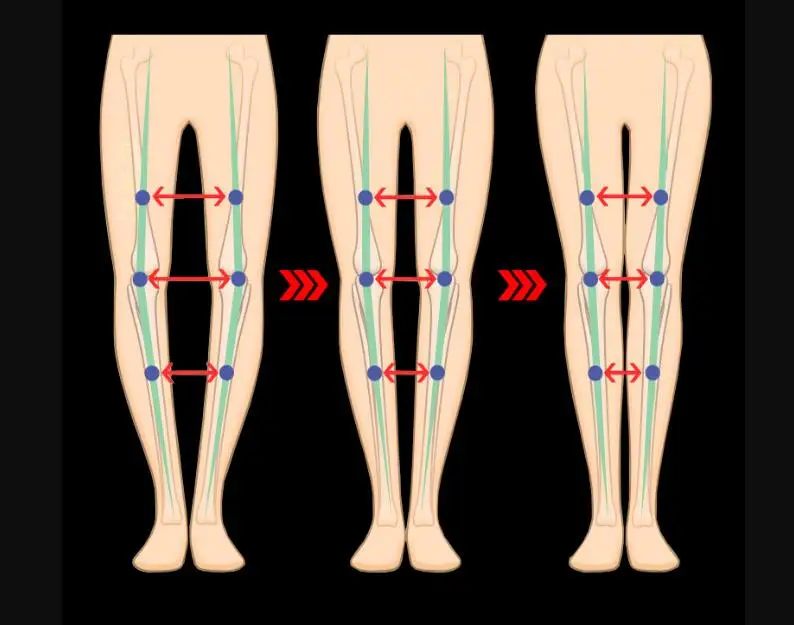 Õige xo jalg ortopeedia o-jalg säärised vööri-jalg sirge jalg artefakt jalg parandus 2